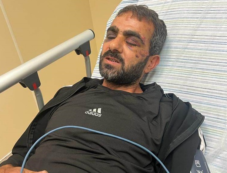 الأسير المحرر محمد زهران عقب الإفراج عنه وآثار اعتداء قوات الاحتلال ظاهرة على جسده