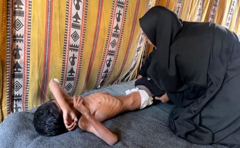 الطفل محمد يعاني من التوحد وسوء التغذية في غزة