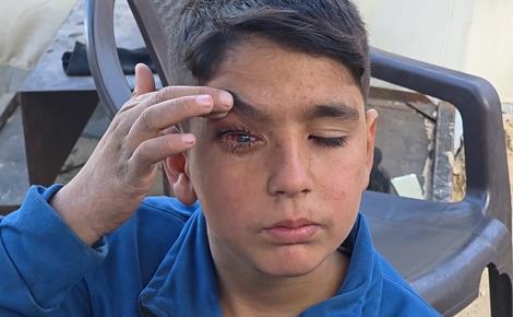  عبد الرحمن مهدد بفقدان بصره بعد الإصابة