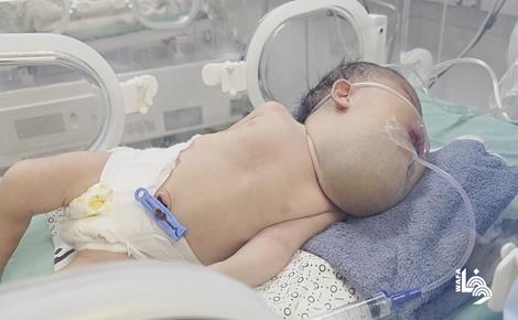 الرضيعة دعاء تحتاج لعلاج خارج غزة لإنقاذ حياتها