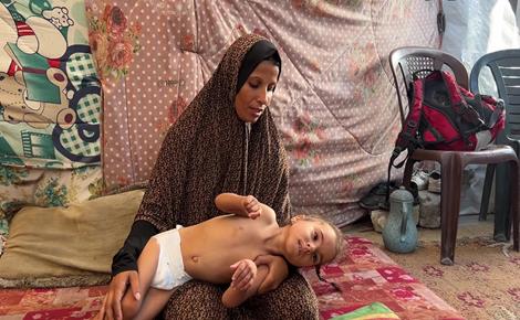 نغم قد تفقد حياتها بسبب التجويع في غزة